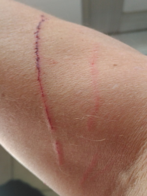scratch from cat
